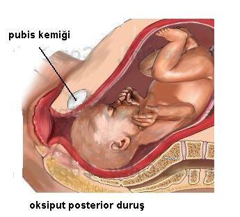 oksiput posterior